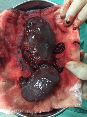 14歲男孩玩耍摔倒，脾臟破裂，險些喪命！