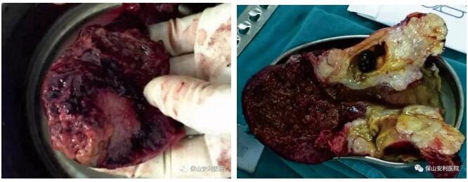 警惕膽囊結石演變成膽囊癌