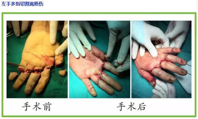 同樣斷指不同結局—斷指保存和康復指導