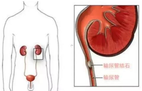 輸尿管結(jié)石，到底能不能保守治療？