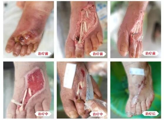 糖尿病并發(fā)癥有多可怕，及時治療糖尿病足避免截肢！