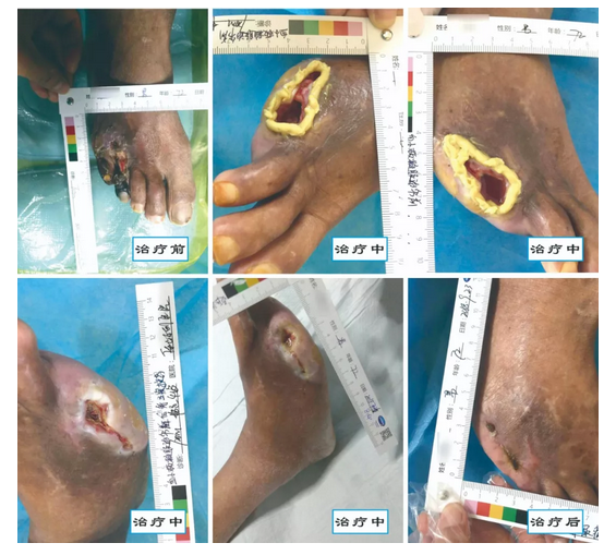 介入治療糖尿病足，您聽說過沒？