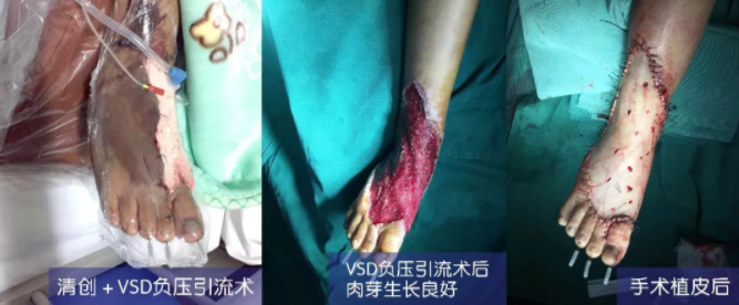 車(chē)禍猛如虎，救治如“華佗” ，手術(shù)＋康復(fù)，8歲小女孩車(chē)禍后日漸康復(fù)行走