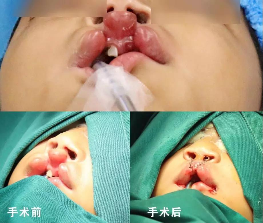 唇腭裂盡早治療消除孩子自卑心理，快樂成長！