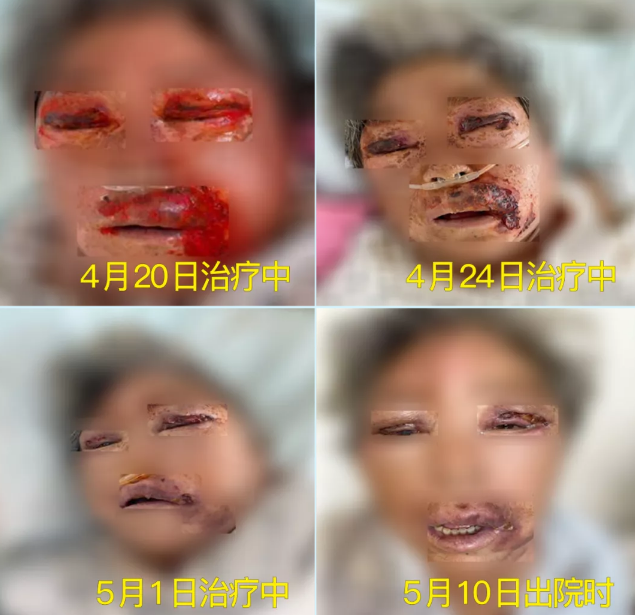 膿毒血癥（急性頜面部蜂窩組織炎）多學(xué)科聯(lián)合會診，幫助患者成功治愈！