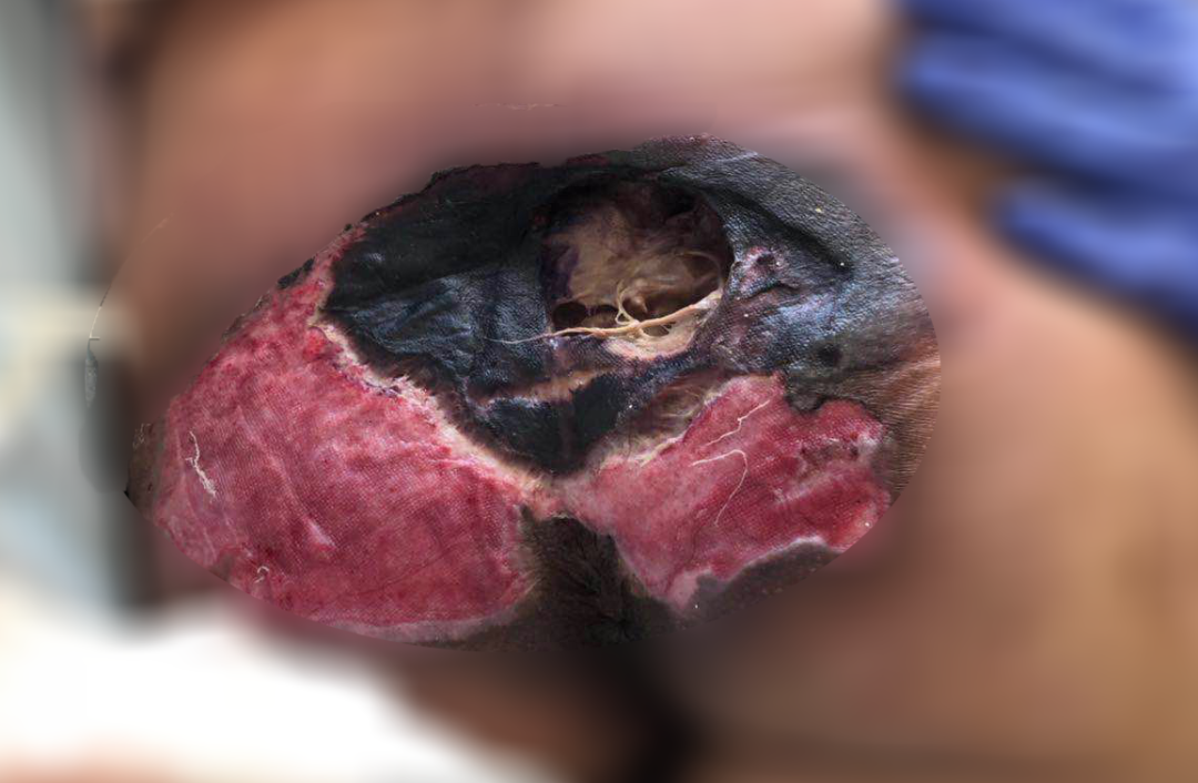 癱瘓3年的女患者臀部居然變成這樣?！