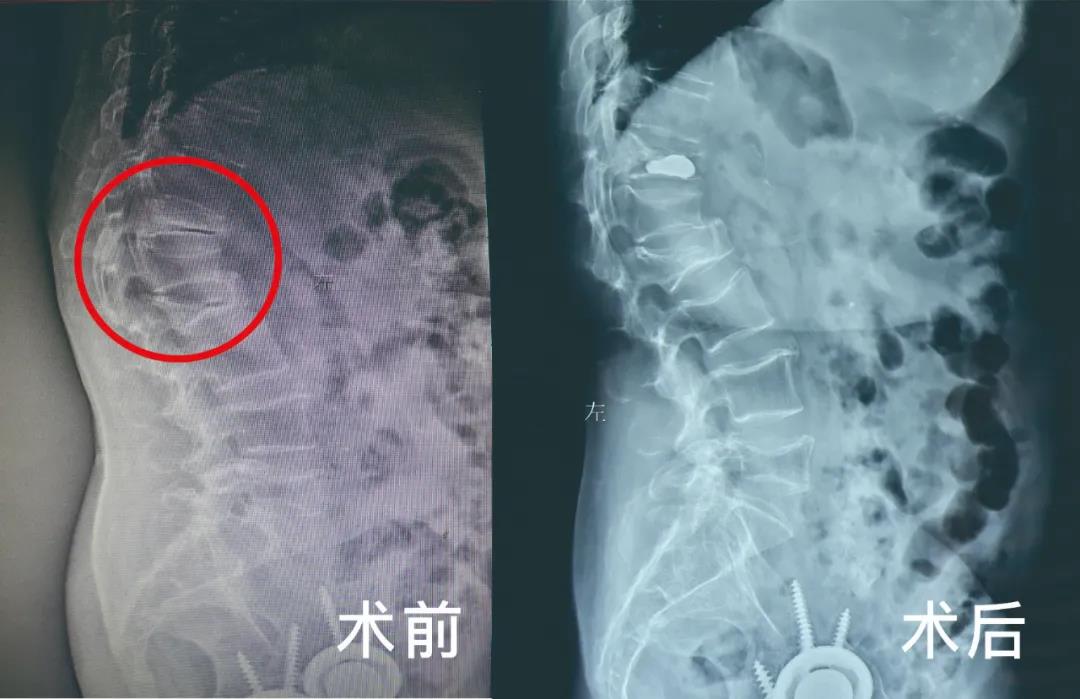 骨質(zhì)疏松導致壓縮性骨折微創(chuàng)手術(shù)療效顯著