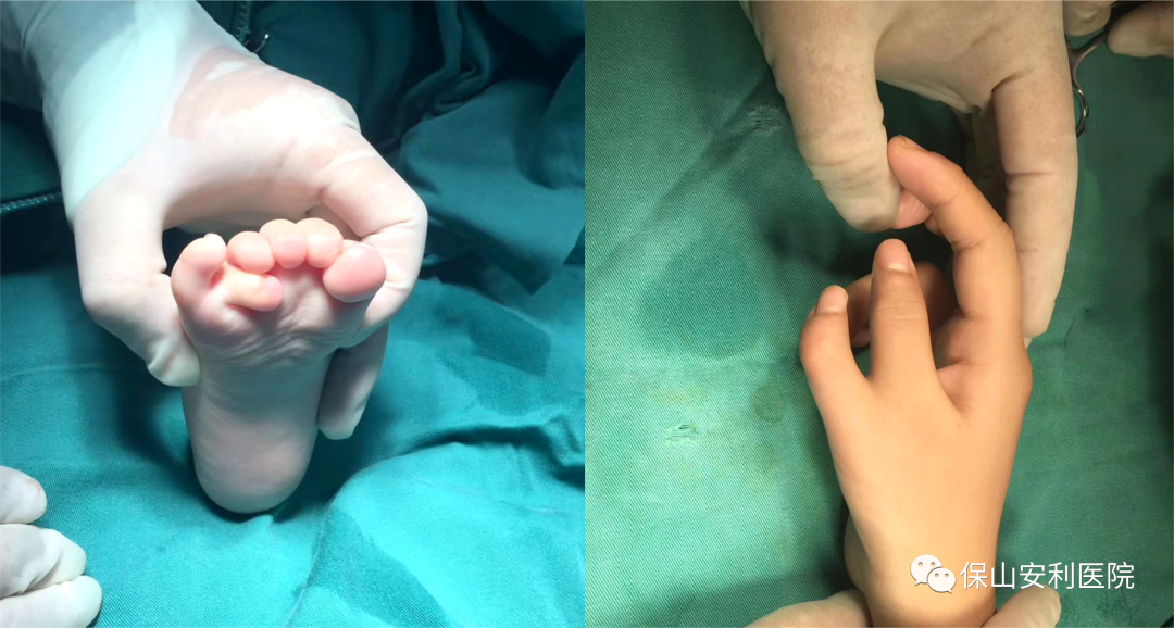 孩子先天手足多指（趾）不要慌，外二科幫你解除困擾！