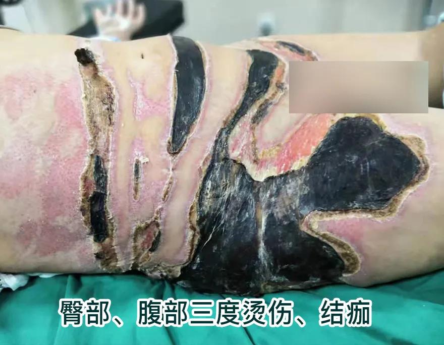 【保山安利醫(yī)院】80歲老人不慎燒傷，導(dǎo)致腹部、右側(cè)臀部大面積創(chuàng)傷，經(jīng)植皮治療創(chuàng)面逐漸愈合