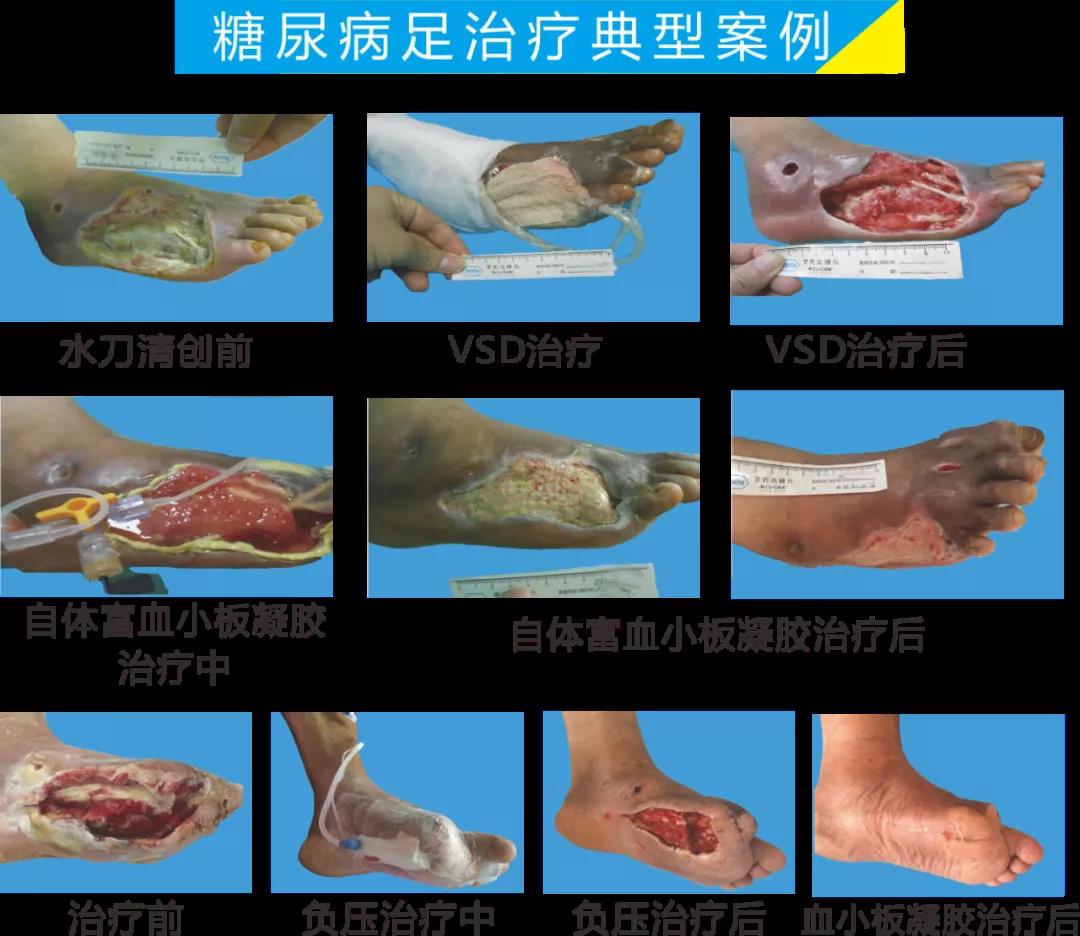 截肢、失明，甚至……，我們要做的是將糖尿病并發(fā)癥遏制在搖籃里！