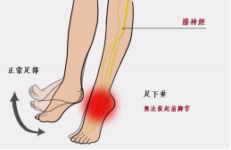 【保山安利醫(yī)院—健康科普】什么是足下垂！你了解嗎？