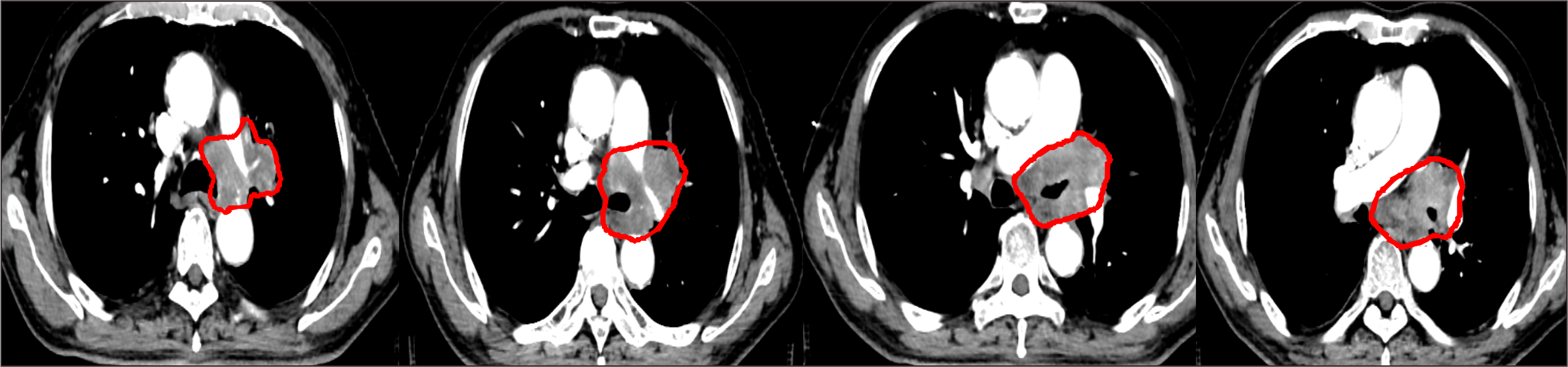 【保山安利醫(yī)院】對于局部晚期非小細胞肺癌患者，手術不能做，化療打不動，該怎么辦？