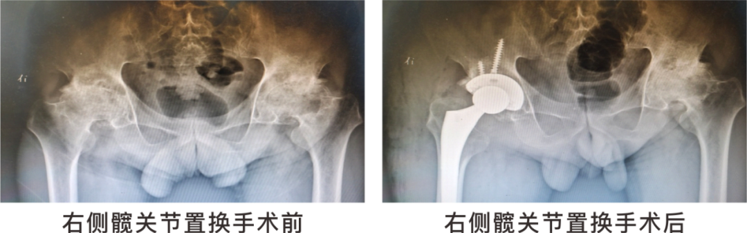 【保山安利醫(yī)院】長期飲酒導致雙側(cè)股骨頭壞死，髖關(guān)節(jié)置換后重獲運動功能！