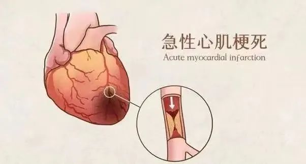 【保山安利醫(yī)院】11月20日“心梗救治日” 時間就是心肌，時間就是生命！